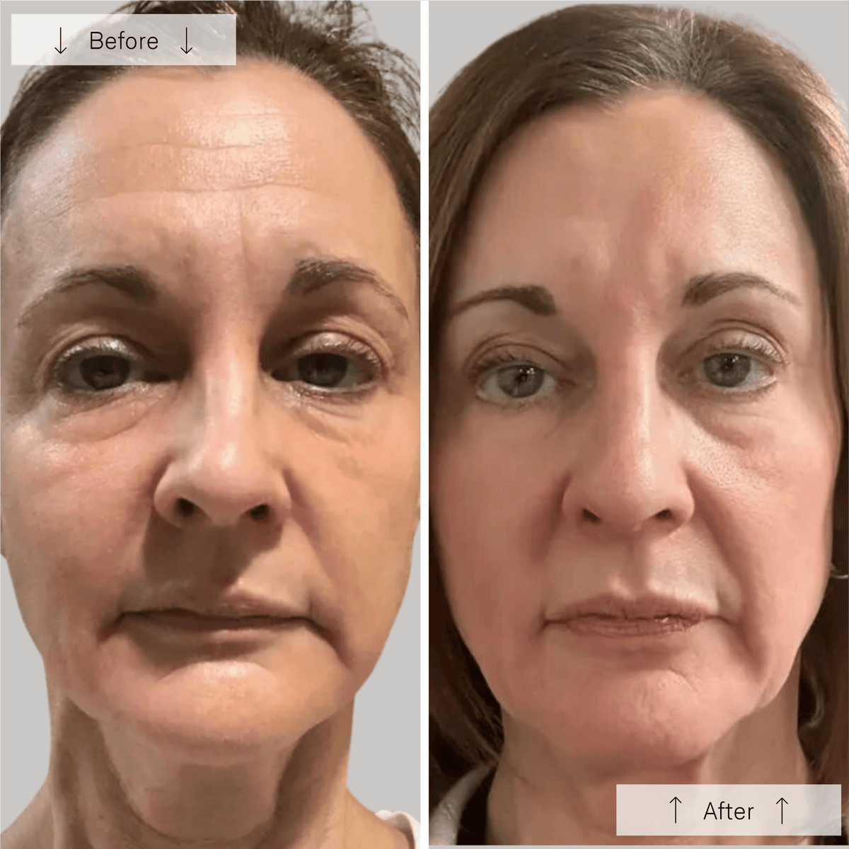 Masque LED pour le visage Omnilux Contour