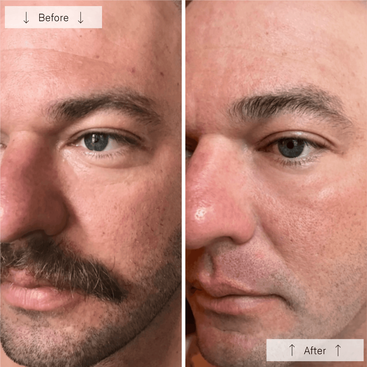 Traitements LED anti-âge Omnilux pour hommes