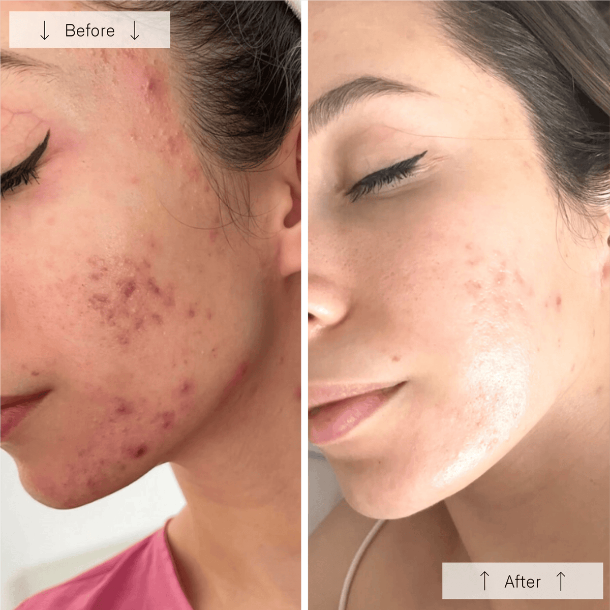 Omnilux Clear Anti-Acne LED Treatments