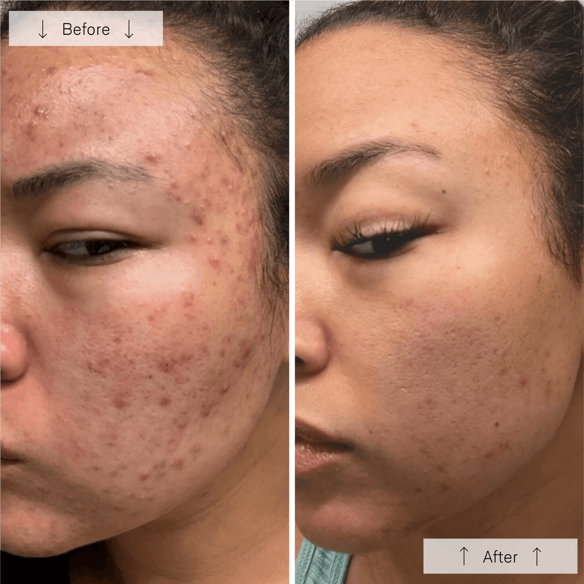 Omnilux Clear Anti-Acne LED Treatments