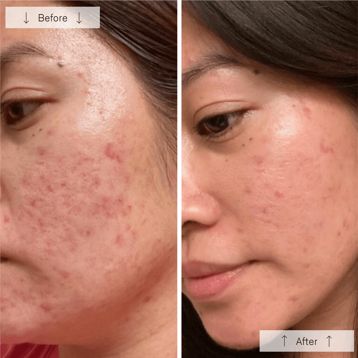 Omnilux Clear Anti-Acne LED Treatments